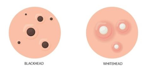 Blackheads & Whiteheads/ foto: Freepik/ Pch.vector Blackheads & Whiteheads