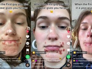 Viral Wanita Kena Herpes Gegara Ciuman, Memang Apa Saja Penularannya? Viral Wanita Kena Herpes Gegara Ciuman, Memang Apa Saja Penularannya?