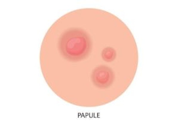 Papules/ foto: Freepik/ Pch.vector Papules