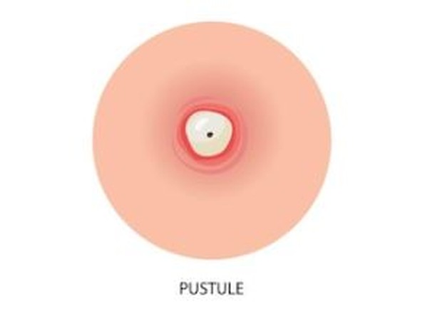 Pustules/ foto: Freepik/ Pch.vector Pustules