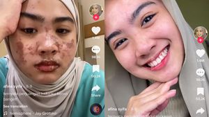Foto Before-After Wanita Bekasi Kena COVID dan Sindrom Langka Sekaligus
