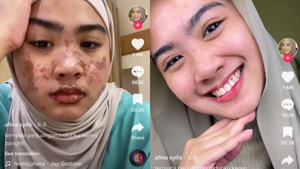 Foto Before-After Wanita Bekasi Kena COVID dan Sindrom Langka Sekaligus