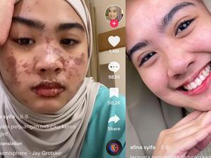 Foto Before-After Wanita Bekasi Kena COVID dan Sindrom Langka Sekaligus