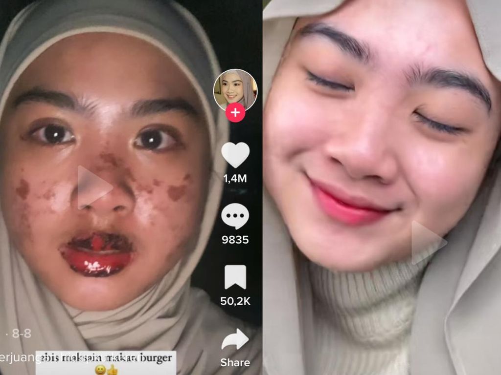 Viral Wanita Bekasi Kena COVID-19 dan Stevens Johnson Syndrome Sekaligus Viral Wanita Bekasi Kena COVID-19 dan Stevens Johnson Syndrome Sekaligus