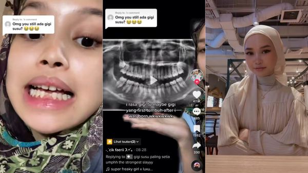 Perempuan 18 Tahun Masih Punya 2 Gigi Susu, Begini Penampakannya