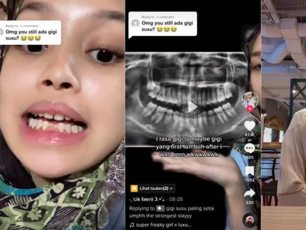 Perempuan 18 Tahun Masih Punya 2 Gigi Susu, Begini Penampakannya