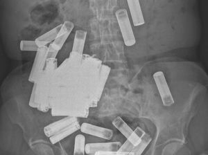 Mengeluh Perut Kram dan Buncit, Dokter Temukan Benda Ini di Tubuhnya