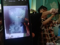 4 Fakta Kunci Gembok Bersarang di Perut Bocah Indramayu