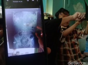 Sekuat Tenaga Ibunda Obati Bocah Penelan Kunci di Indramayu Sekuat Tenaga Ibunda Obati Bocah Penelan Kunci di Indramayu