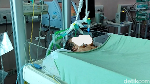 Potret Bayi Kembar Siam Lahir dengan 2 Kepala 1 Badan di Pariaman