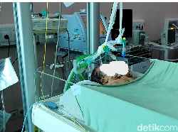 Bayi Kembar Siam 2 Kepala Dirawat 25 Tenaga Medis di RSUP M Djamil