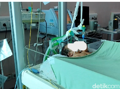 Potret Bayi Kembar Siam Lahir dengan 2 Kepala 1 Badan di Pariaman