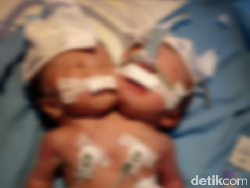 Bayi Kembar Siam Lahir di Pariaman, 2 Kepala 1 Badan