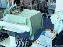 Bayi Kembar Siam 2 Kepala Asal Pariaman Hanya Berumur 3 Hari