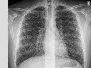 Awas Vapers Bisa Kena Kerusakan Paru Popcorn Lung, Kondisi Apa Itu?