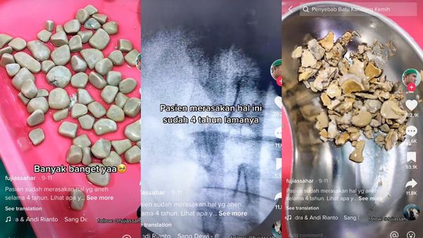 Penampakan Batu Kandung Kemih yang Mengendap Selama 4 Tahun, Inikah Penyebabnya?