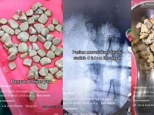 Pasien Timbun Batu Kandung Kemih Selama 4 Tahun, Begini Kejadian dan Gejalanya Pasien Timbun Batu Kandung Kemih Selama 4 Tahun, Begini Kejadian dan Gejalanya