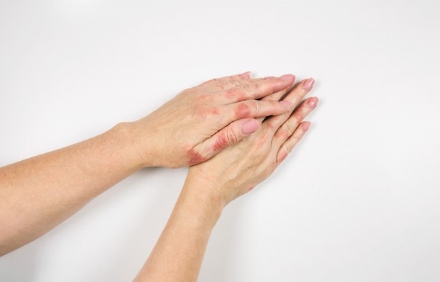 Pantenol dapat meringankan gatal karena eksim/Foto: Freepik/elena_gr Fakta menarik dan manfaat kandungan pantenol dalam produk skincare