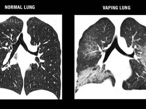 Yakin Nggak Mau Tobat Ngevape? Ini Penampakan Paru-paru Sehat Vs Vapers