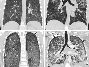 Awas! Ini 4 Penyakit Serius gegara Sering Nge-Vape