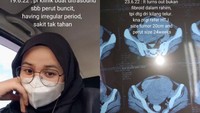 Viral Gadis 22 Tahun Punya Tumor 2 Kg di Rahim, Ini Gejala Awal yang Muncul