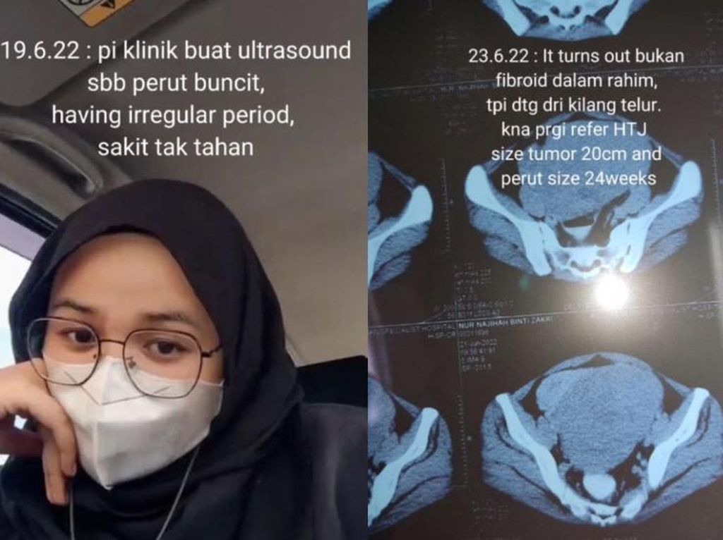 Viral Kisah Wanita 22 Tahun Punya Tumor 2 Kg di Rahim, Buncit bak Hamil Viral Kisah Wanita 22 Tahun Punya Tumor 2 Kg di Rahim, Buncit bak Hamil