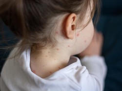 Khawatirnya Ilmuwan Dunia dengan Kebangkitan Penyakit Campak