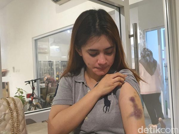 Foto-foto Bekas Luka Korban Usai Disekap-Dianiaya Oknum Polwan