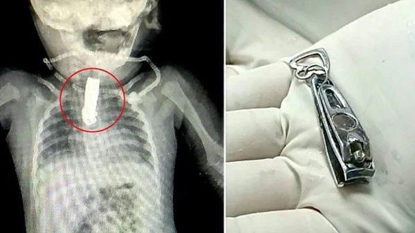 Ngilu! Potret Operasi Dijalani Bayi 8 Bulan Akibat Telan Gunting Kuku