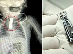 Ortu Lalai, Bayi 8 Bulan Telan Gunting Kuku Sampai Nyangkut di Tenggorokan