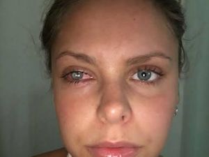 Gara-gara Tas Makeup Kotor, Mata Wanita Ini Bernanah Hingga Jadi Buta