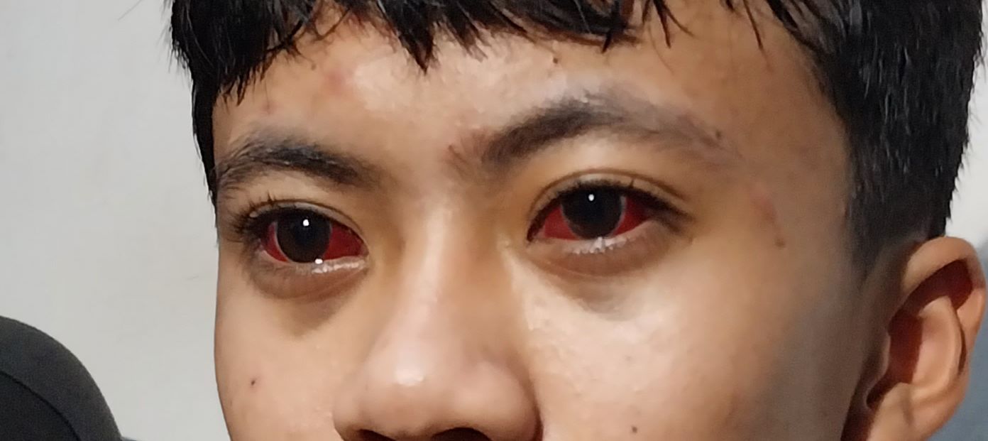 korban kanjuruhan malang matanya merah terkena gas air mata