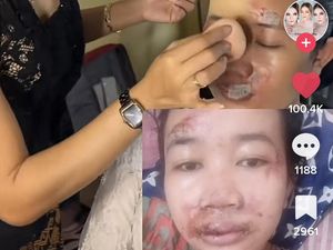 Viral Pengantin Kecelakaan Jelang Hari-H, Luka Masih Basah, Dirias Jadi Begini
