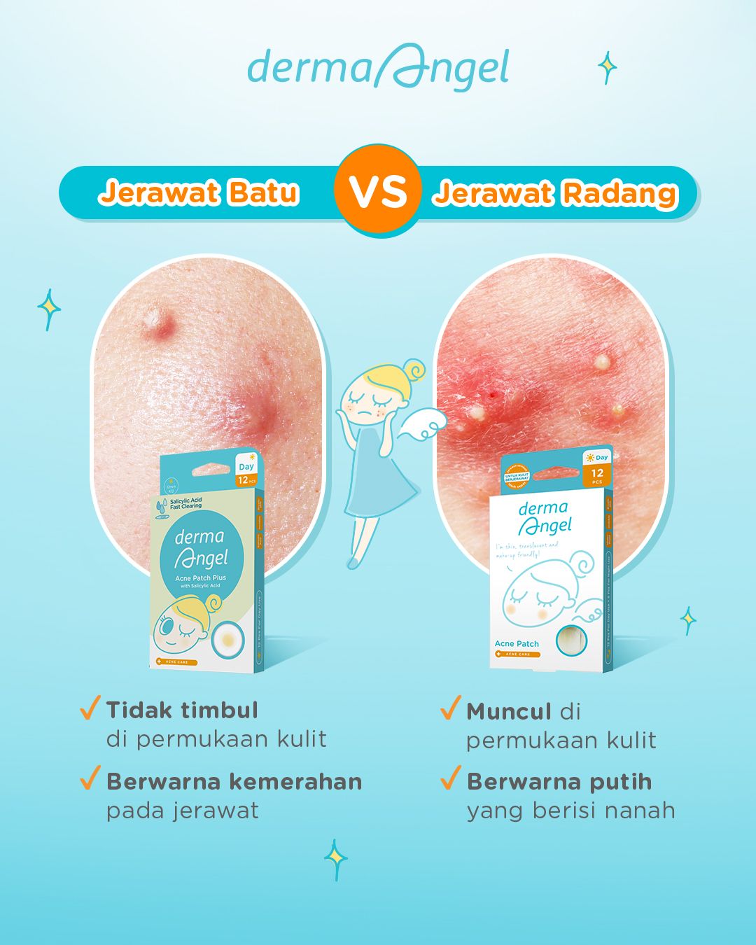 Derma Angel Acne Patch Plus dengan Salicylic Acid, Bisa Redakan Jerawat