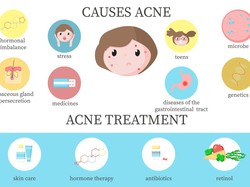 Ragam Penyebab Munculnya Jerawat, Bisa karena Keturunan