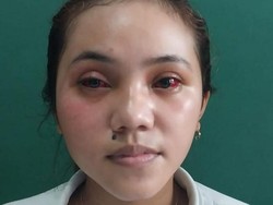 Cerita Kevia Kakinya Nyangkut Pagar Saat Hindari Gas Air Mata Kedaluwarsa