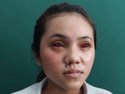7 Fakta Mahasiswi Widyagama Mata-Wajah Merah Kena Gas Air Mata Kedaluwarsa