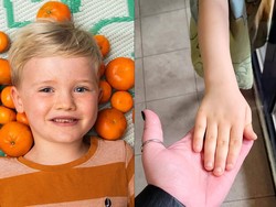 Kebanyakan Makan Jeruk, Kulit Anak Ini Berubah Oranye