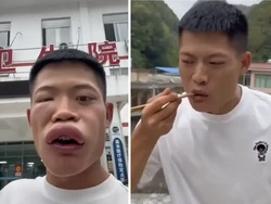 Demi Viral, Orang Ini Rela Makan Laba-laba hingga Lebah Sampai Wajah Bengkak