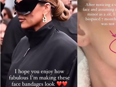7 Foto Khloe Kardashian yang Idap Kanker Kulit Langka, Ketahuan gegara Ini