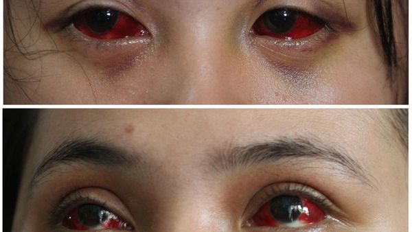 Potret Pilu Korban Luka Tragedi Kanjuruhan