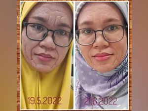 Wanita 37 Tahun Punya Wajah Keriput Mirip Nenek-nenek, Ternyata Sakit...