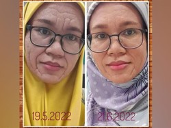 Wanita 37 Tahun Punya Wajah Keriput Mirip Nenek-nenek, Ternyata Sakit...