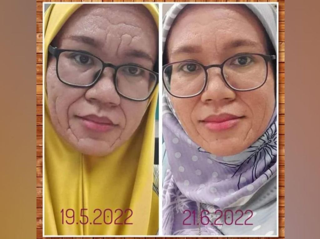 Wanita 37 Tahun Punya Wajah Keriput Mirip Nenek-nenek, Ternyata Sakit... Wanita 37 Tahun Punya Wajah Keriput Mirip Nenek-nenek, Ternyata Sakit...