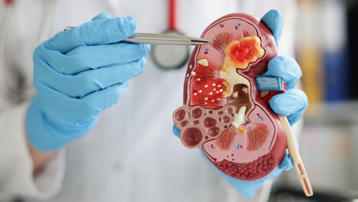 Close-up of urologist pointing pen kidney structure on anatomical model. Treatment of kidney diseases, pyelonephritis