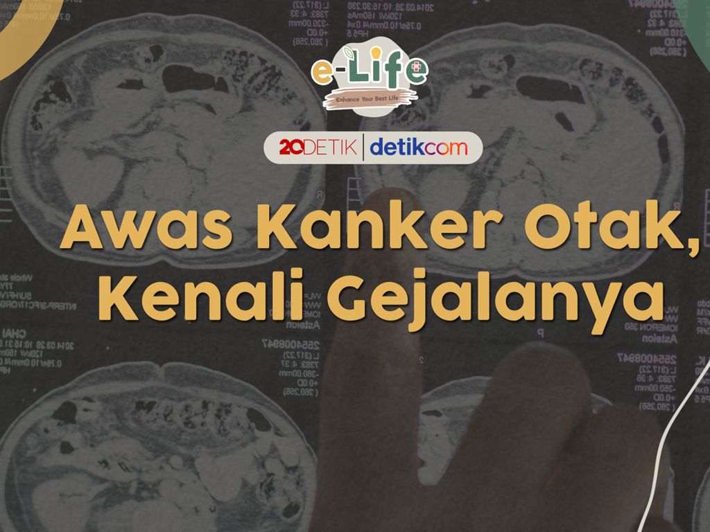 Sakit Kepala karena Kanker Otak, Apa Bedanya? Ini Penjelasan Dokter Sakit Kepala karena Kanker Otak, Apa Bedanya? Ini Penjelasan Dokter