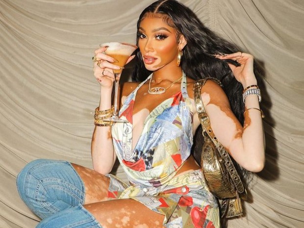 Winnie Harlow melawan standar kecantikan sejak kecil