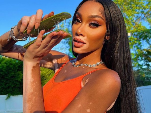 Winnie Harlow melawan standar kecantikan sejak kecil