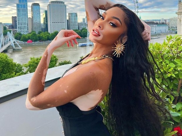 Winnie Harlow melawan standar kecantikan sejak kecil