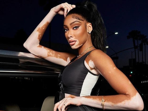 Winnie Harlow melawan standar kecantikan sejak kecil